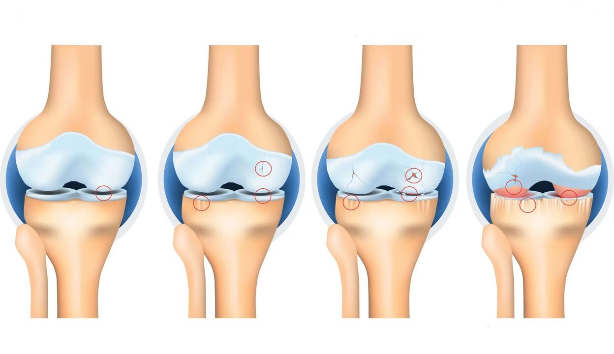 arthrosis na gidajen abinci